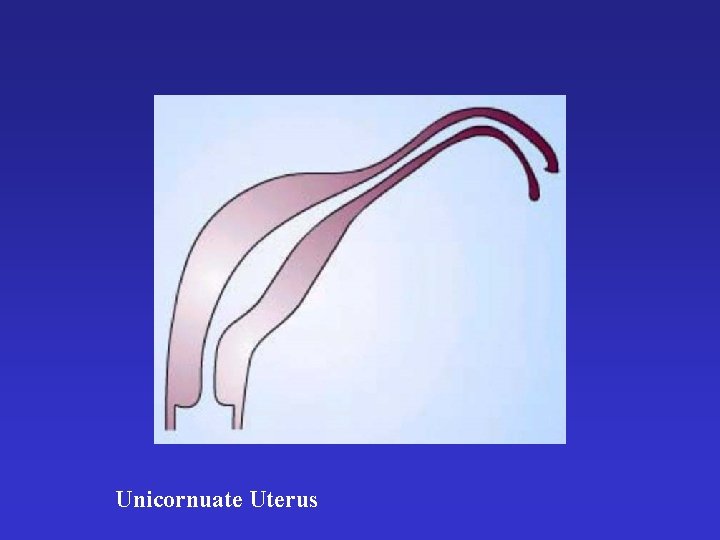 Unicornuate Uterus 