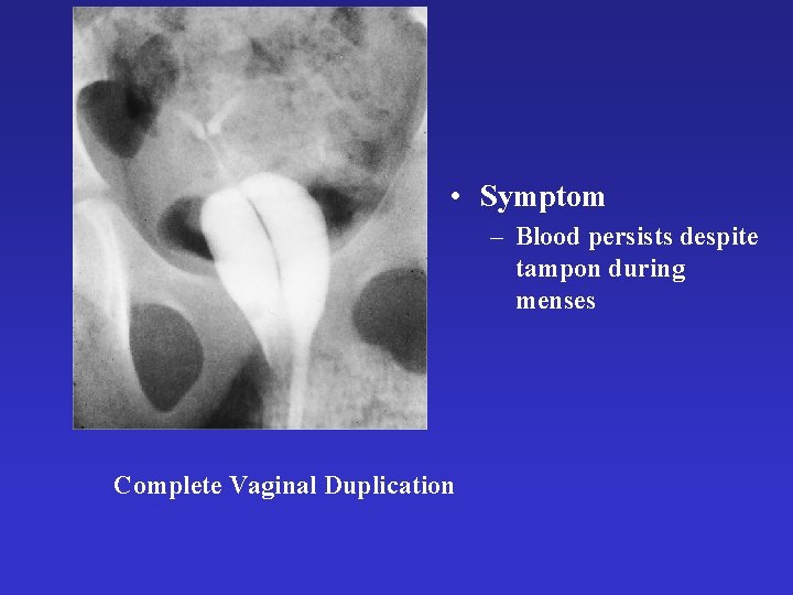  • Symptom – Blood persists despite tampon during menses Complete Vaginal Duplication 