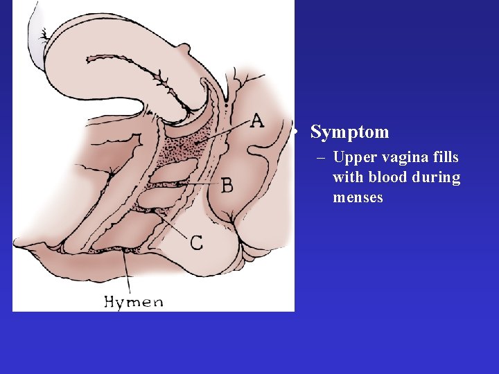  • Symptom – Upper vagina fills with blood during menses 