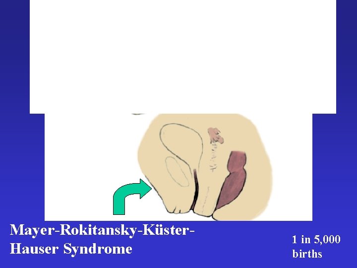 Mayer-Rokitansky-Küster. Hauser Syndrome 1 in 5, 000 births 