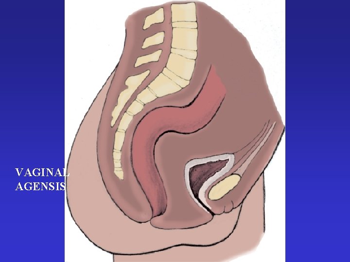 VAGINAL AGENSIS 