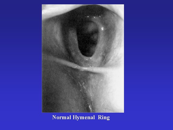 Normal Hymenal Ring 