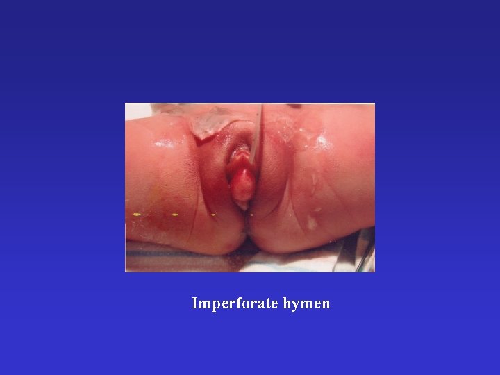 Imperforate hymen 