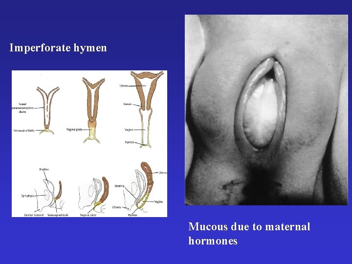 Imperforate hymen Mucous due to maternal hormones 