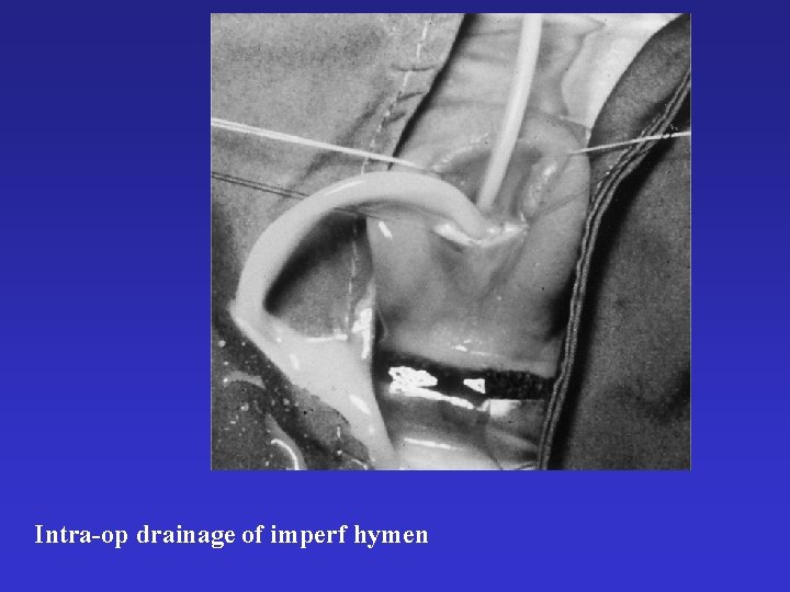 Intra-op drainage of imperf hymen 