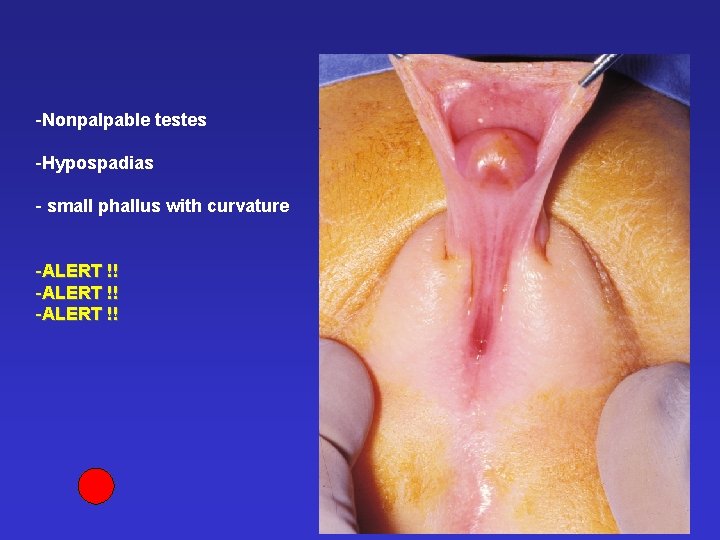 -Nonpalpable testes -Hypospadias - small phallus with curvature -ALERT !! 