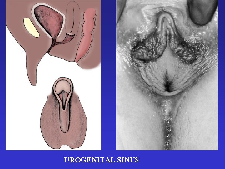 UROGENITAL SINUS 