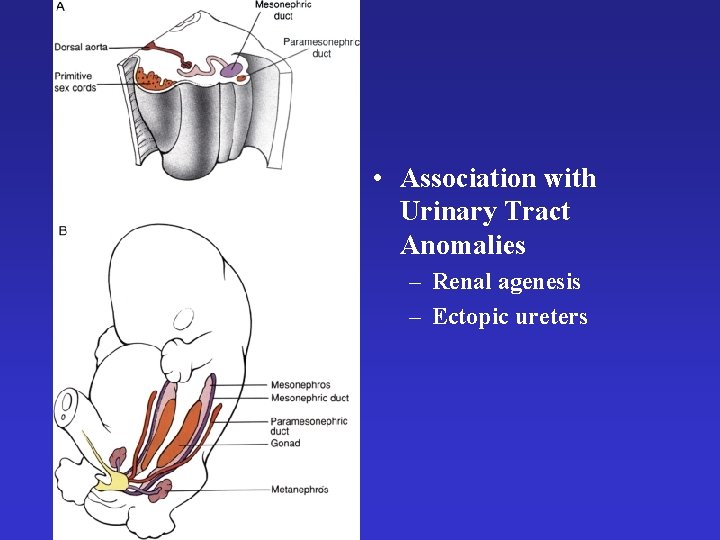  • Association with Urinary Tract Anomalies – Renal agenesis – Ectopic ureters 