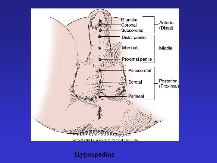 Hypospadias 