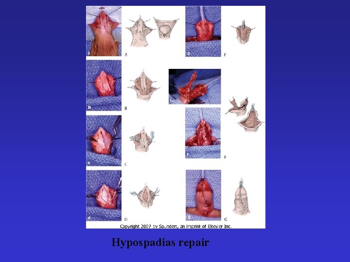 Hypospadias repair 