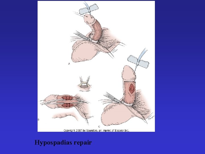 Hypospadias repair 