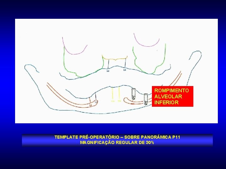 ROMPIMENTO ALVEOLAR INFERIOR TEMPLATE PRÉ-OPERATÓRIO – SOBRE PANORÁMICA P 11 MAGNIFICAÇÃO REGULAR DE 30%