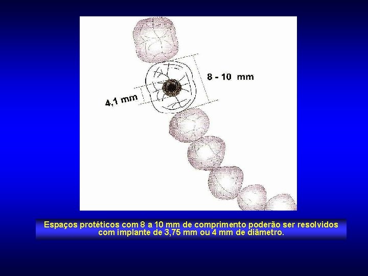 Espaços protéticos com 8 a 10 mm de comprimento poderão ser resolvidos com implante