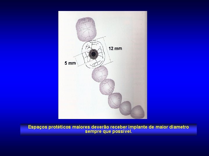 Espaços protéticos maiores deverão receber implante de maior diametro sempre que possível. 