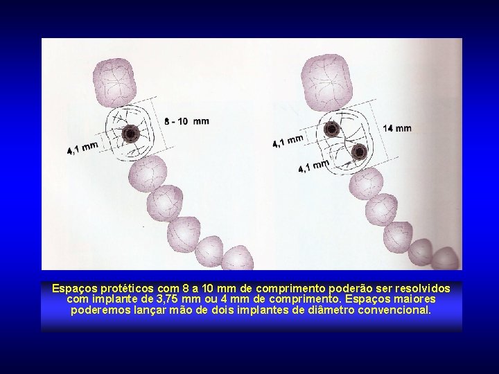 Espaços protéticos com 8 a 10 mm de comprimento poderão ser resolvidos com implante