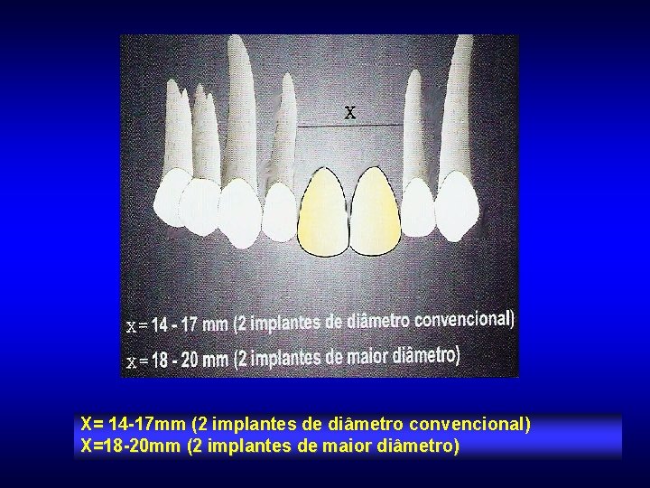 X= 14 -17 mm (2 implantes de diâmetro convencional) X=18 -20 mm (2 implantes