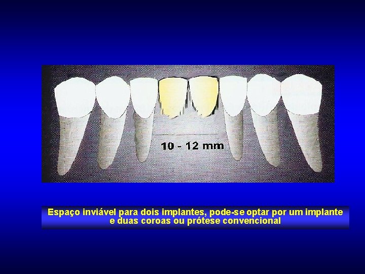 Espaço inviável para dois implantes, pode-se optar por um implante e duas coroas ou