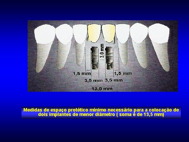 Medidas de espaço protético mínimo necessário para a colocação de dois implantes de menor