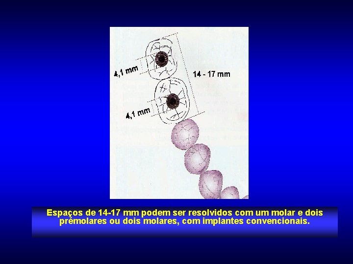 Espaços de 14 -17 mm podem ser resolvidos com um molar e dois prémolares