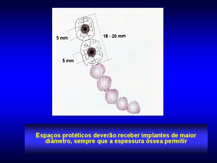 Espaços protéticos deverão receber implantes de maior diâmetro, sempre que a espessura óssea permitir