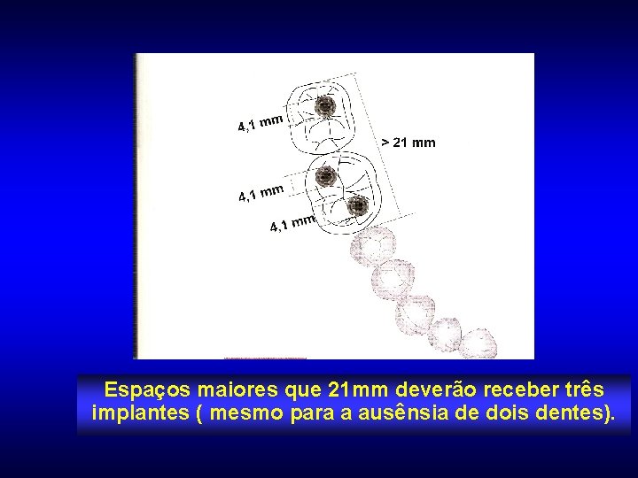 Espaços maiores que 21 mm deverão receber três implantes ( mesmo para a ausênsia