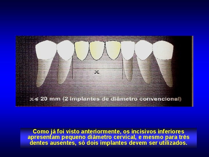 Como já foi visto anteriormente, os incisivos inferiores apresentam pequeno diâmetro cervical, e mesmo