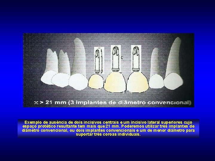 Exemplo de ausência de dois incisivos centrais e um incisivo lateral superiores cujo espaço