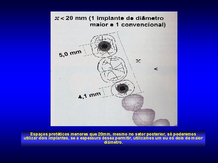 Espaços protéticos menores que 20 mm, mesmo no setor posterior, só poderemos utilizar dois