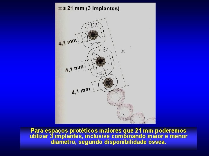 Para espaços protéticos maiores que 21 mm poderemos utilizar 3 implantes, inclusive combinando maior