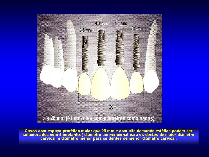 Casos com espaço protético maior que 28 mm e com alta demanda estética podem