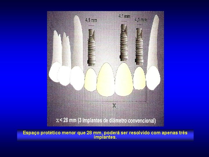 Espaço protético menor que 28 mm, poderá ser resolvido com apenas três implantes. 