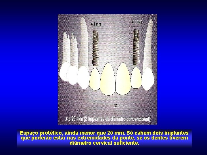 Espaço protético, ainda menor que 20 mm. Só cabem dois implantes que poderão estar