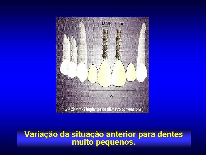 Variação da situação anterior para dentes muito pequenos. 