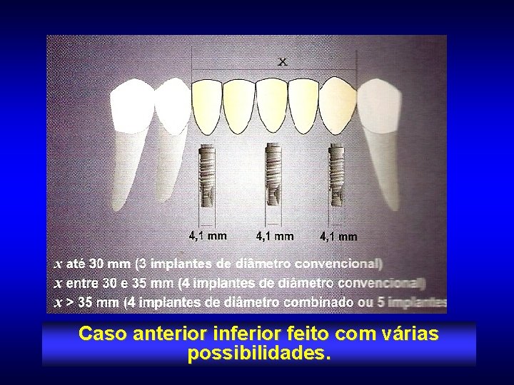 Caso anterior inferior feito com várias possibilidades. 