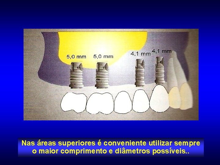 Nas áreas superiores é conveniente utilizar sempre o maior comprimento e diâmetros possíveis. .