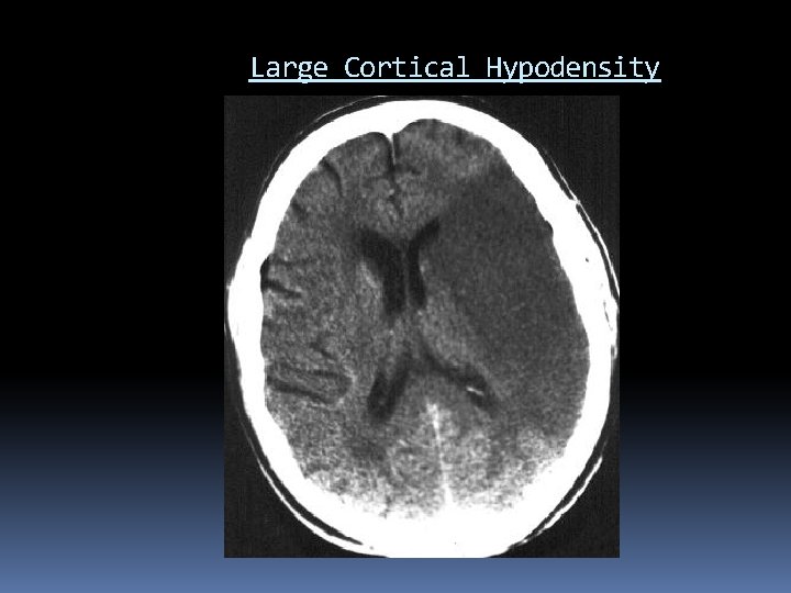 Large Cortical Hypodensity 