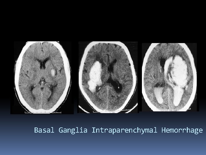 Basal Ganglia Intraparenchymal Hemorrhage 