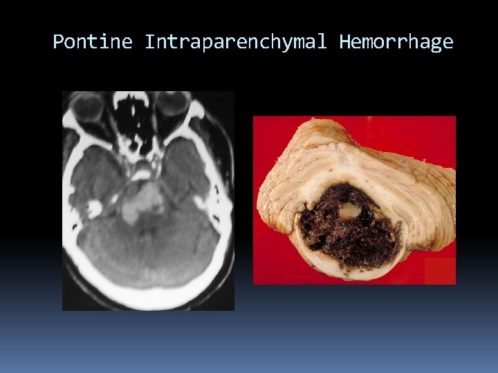 Pontine Intraparenchymal Hemorrhage 