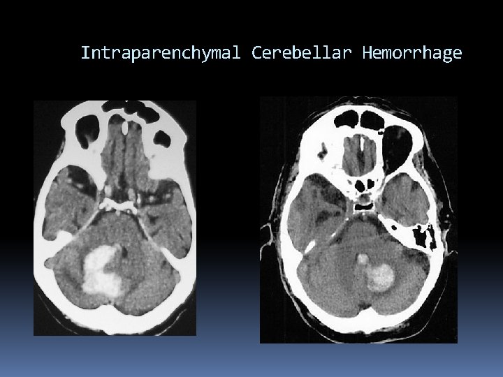Intraparenchymal Cerebellar Hemorrhage 