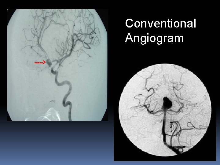 Conventional Angiogram 