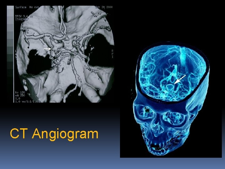 CT Angiogram 