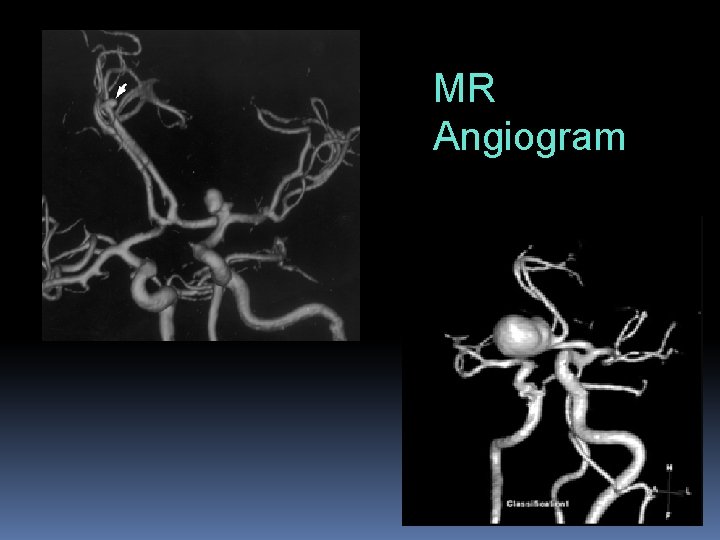 MR Angiogram 