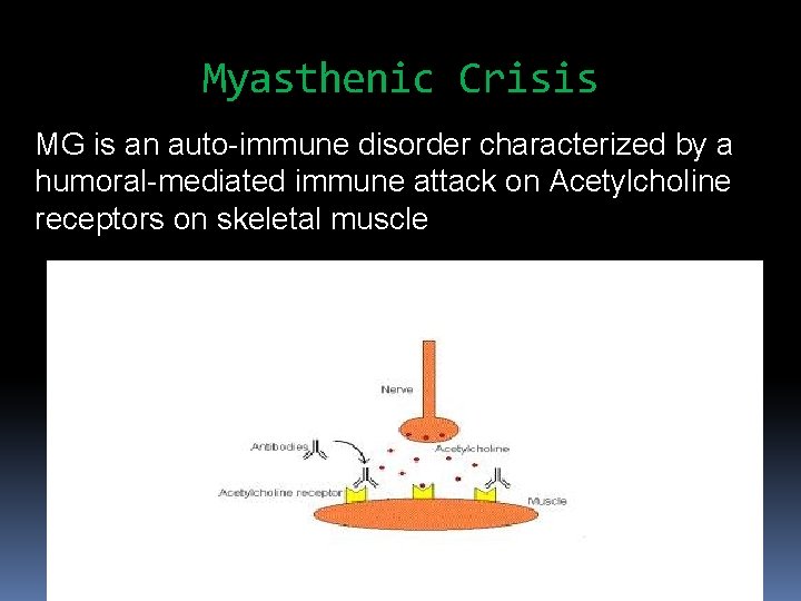 Myasthenic Crisis MG is an auto-immune disorder characterized by a humoral-mediated immune attack on