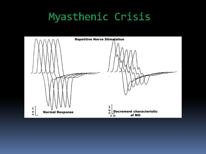 Myasthenic Crisis 