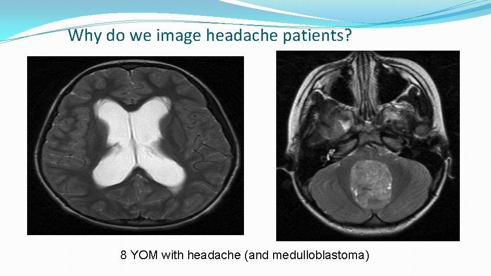 Why do we image headache patients? 8 YOM with headache (and medulloblastoma) 