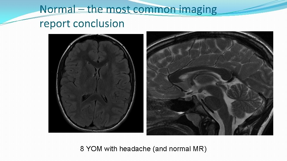 Normal – the most common imaging report conclusion 8 YOM with headache (and normal