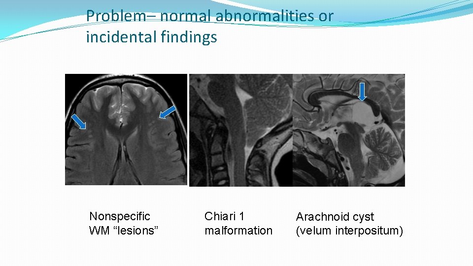 Problem– normal abnormalities or incidental findings Nonspecific WM “lesions” Chiari 1 malformation Arachnoid cyst