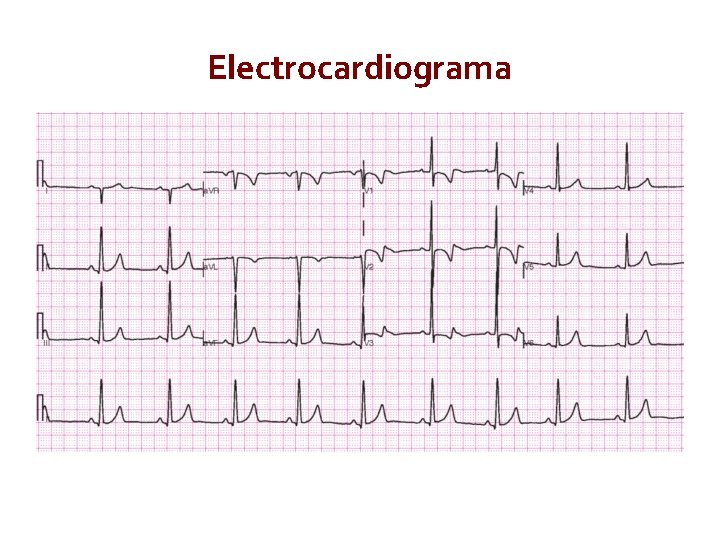 Electrocardiograma Circulation, 2009. 119: 2250 -2294 Electrocardiograma Circulation, 2009. 119: 2250 -2294