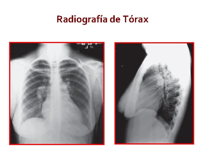 Radiografía de Tórax Circulation, 2009. 119: 2250 -2294 