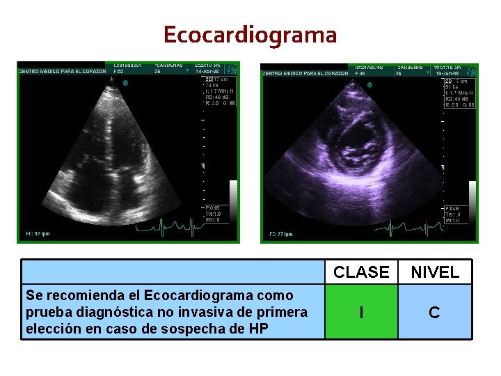 Ecocardiograma Se recomienda el Ecocardiograma como prueba diagnóstica no invasiva de primera elección en